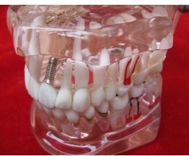 华康齿科牙科材料 口腔牙齿模型病理模型 成人病理模型 特价