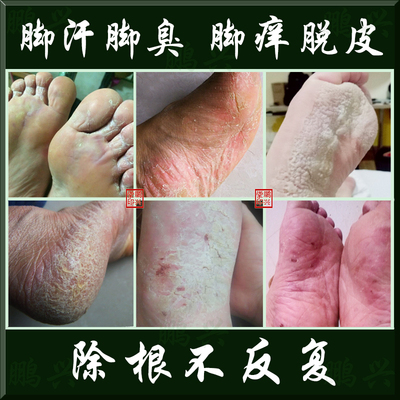脚臭神器治脚气脚痒脱皮去除糜烂水泡型脚气烂脚丫香港脚真菌感染